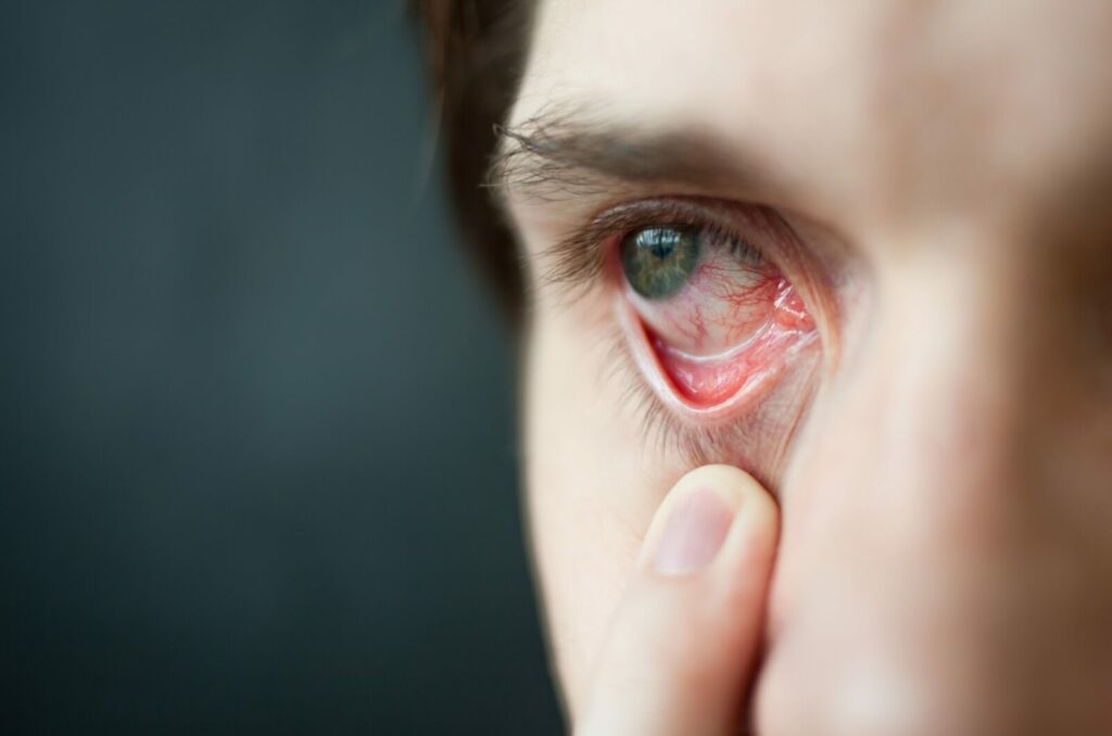 A person tugs their lower eyelid down, exposing a red eye.