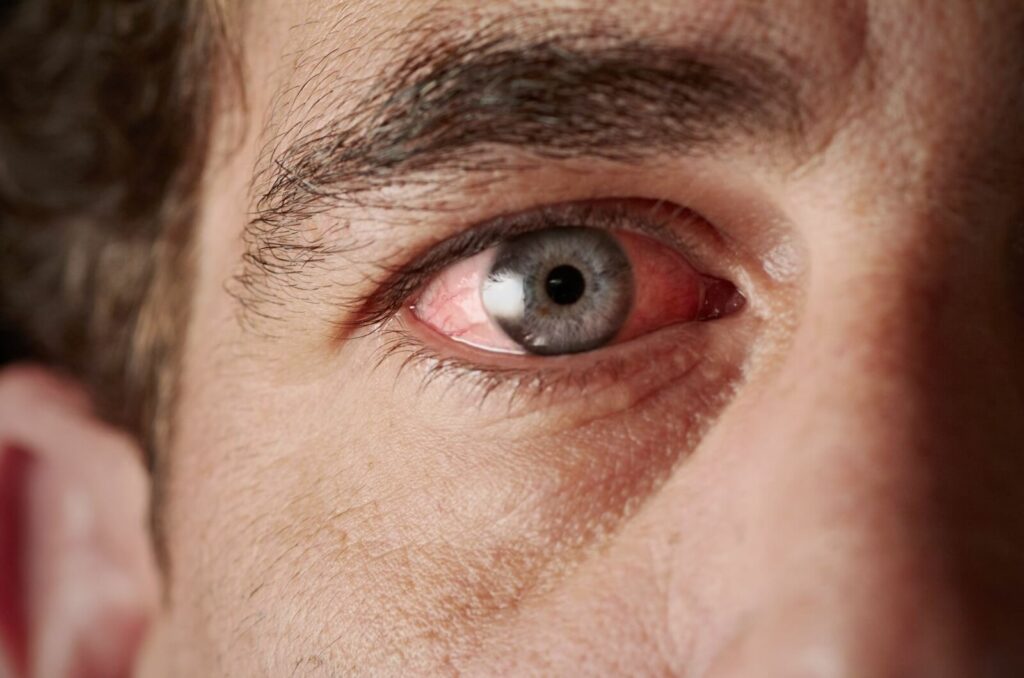 A close-up image of a red and inflamed eye due to some form of pink eye.