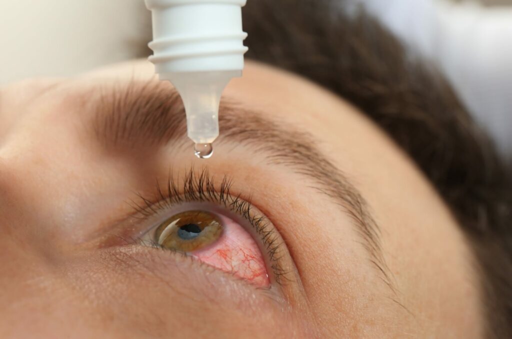 Close-up of a person applying eye drops to their inflamed eyes.