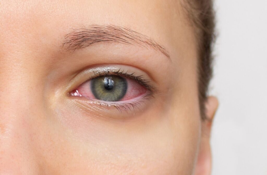 A close-up image of an adult's left eye showing signs of inflammation due to pink eye.