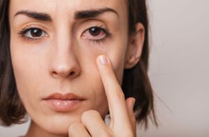 A person with a red, irritated eye.