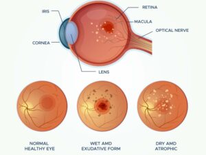 Eye anatomy with wet and dry AMD comparison